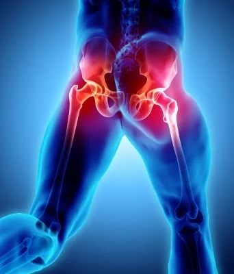 Avascular Necrosis ( AVN ): How to prevent Hip joint Surgery and Replacement, A Natural Side effects free remedy.